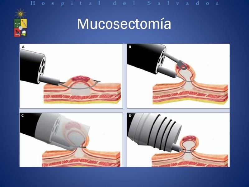 Diapositiva 20 de Mucosectomía Endoscópica en Cáncer Esofágico Superficial y Rol de la Endosonografía