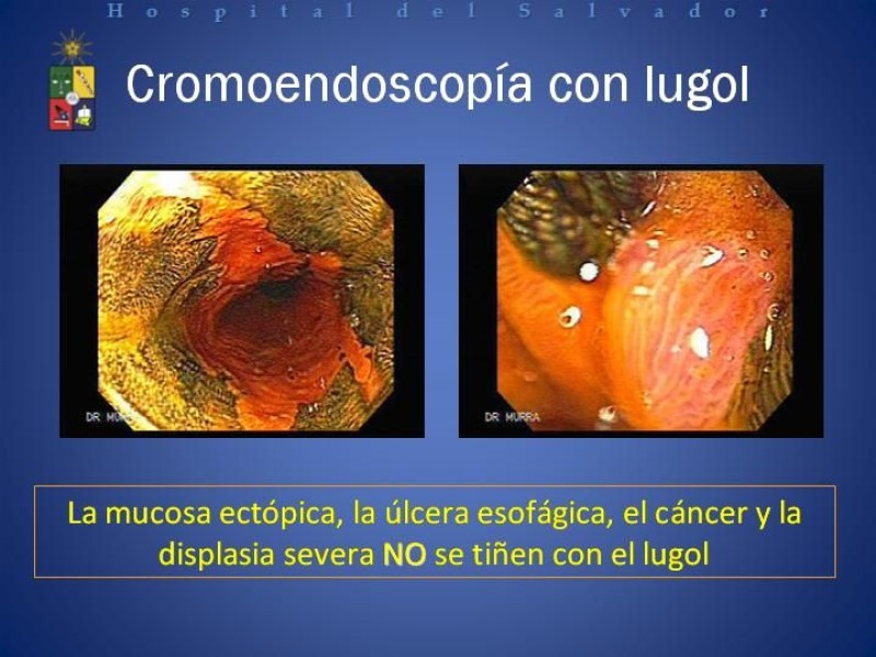Diapositiva 6 de Mucosectomía Endoscópica en Cáncer Esofágico Superficial y Rol de la Endosonografía