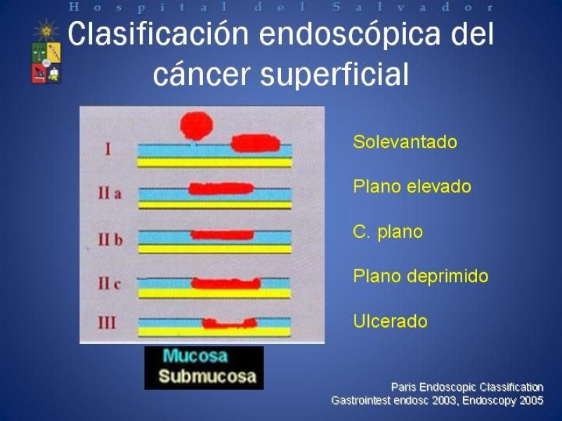 Diapositiva 8 de Mucosectomía Endoscópica en Cáncer Esofágico Superficial y Rol de la Endosonografía