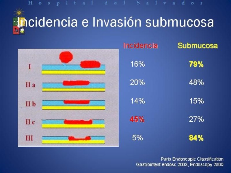 Diapositiva 9 de Mucosectomía Endoscópica en Cáncer Esofágico Superficial y Rol de la Endosonografía