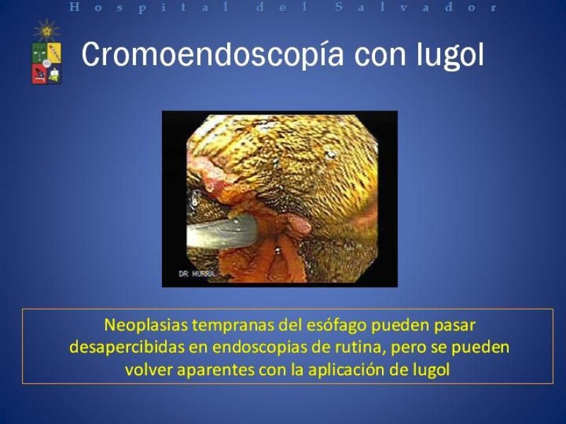 Diapositiva 7 de Mucosectomía Endoscópica en Cáncer Esofágico Superficial y Rol de la Endosonografía