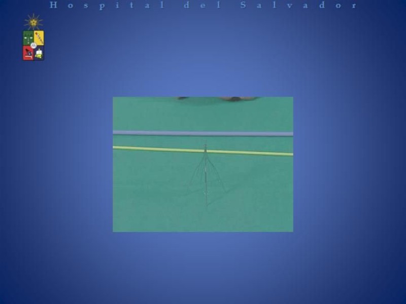 Diapositiva 14 de Filtro de vena Cava