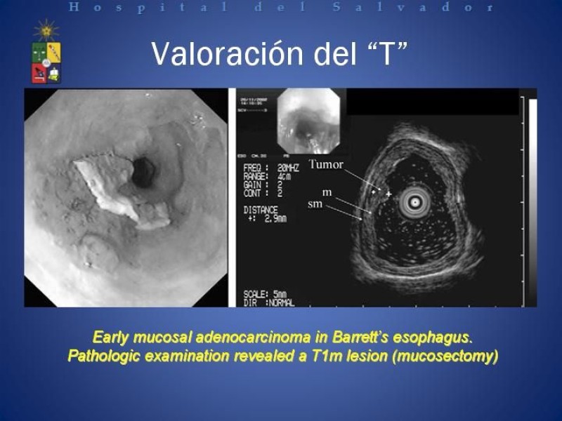 Diapositiva 12 de Mucosectomía Endoscópica en Cáncer Esofágico Superficial y Rol de la Endosonografía