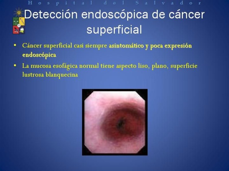 Diapositiva 4 de Mucosectomía Endoscópica en Cáncer Esofágico Superficial y Rol de la Endosonografía