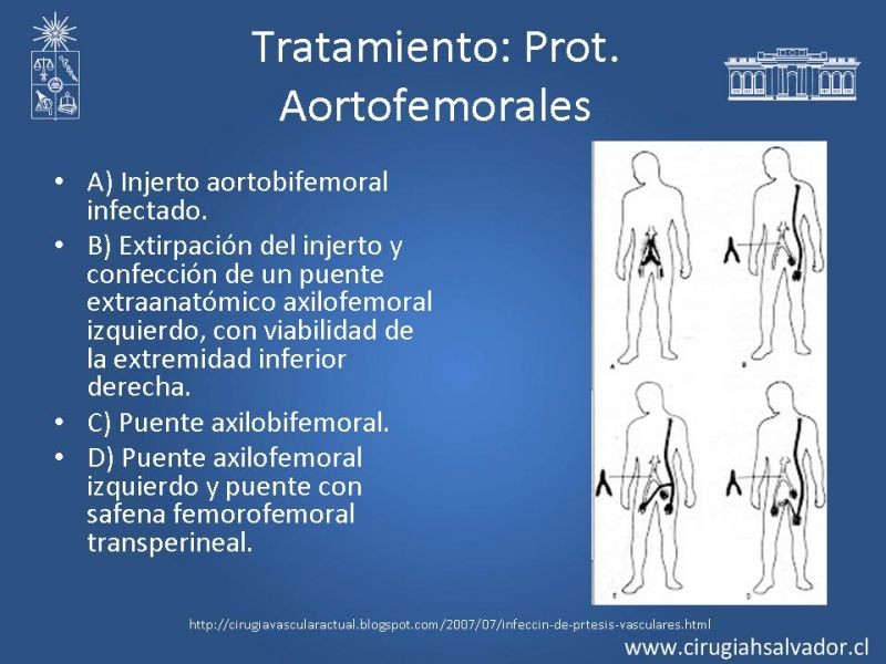 Diapositiva 21 de Infección de prótesis vasculares 