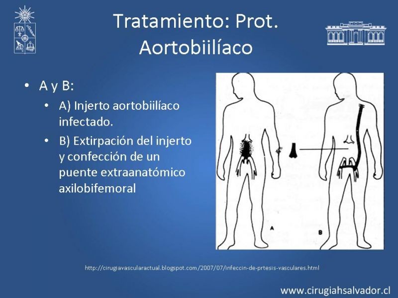 Diapositiva 20 de Infección de prótesis vasculares 