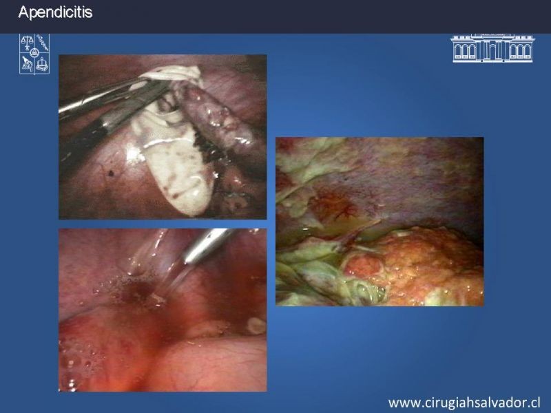 Diapositiva 13 de Apendicectomía: Abierta vs Laparoscópica 