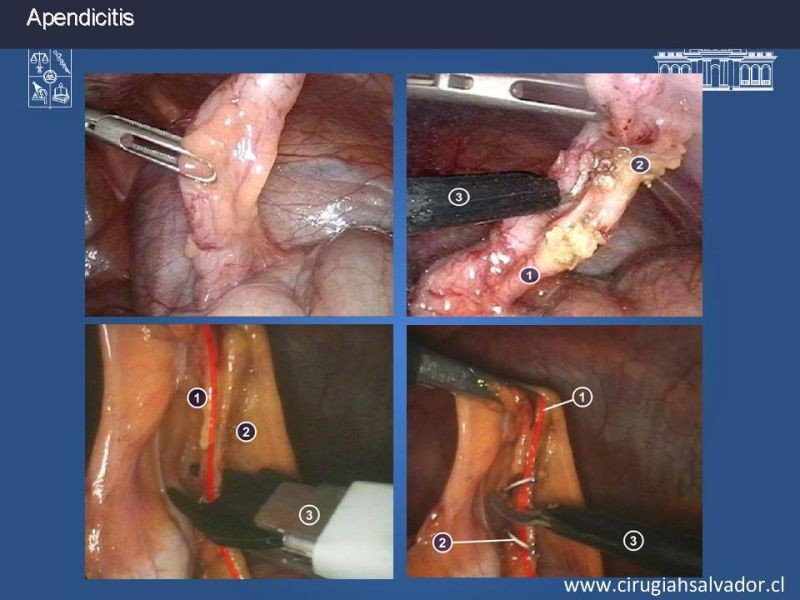 Diapositiva 11 de Apendicectomía: Abierta vs Laparoscópica 