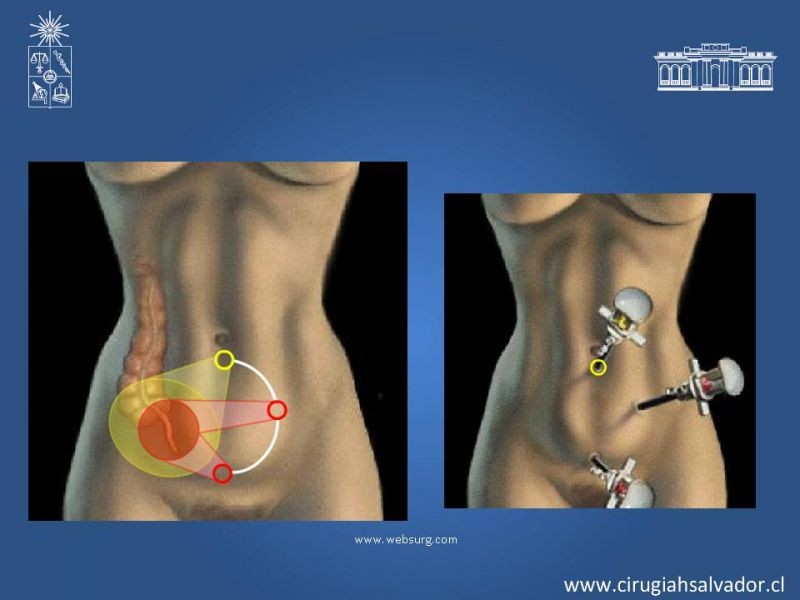Diapositiva 10 de Apendicectomía: Abierta vs Laparoscópica 