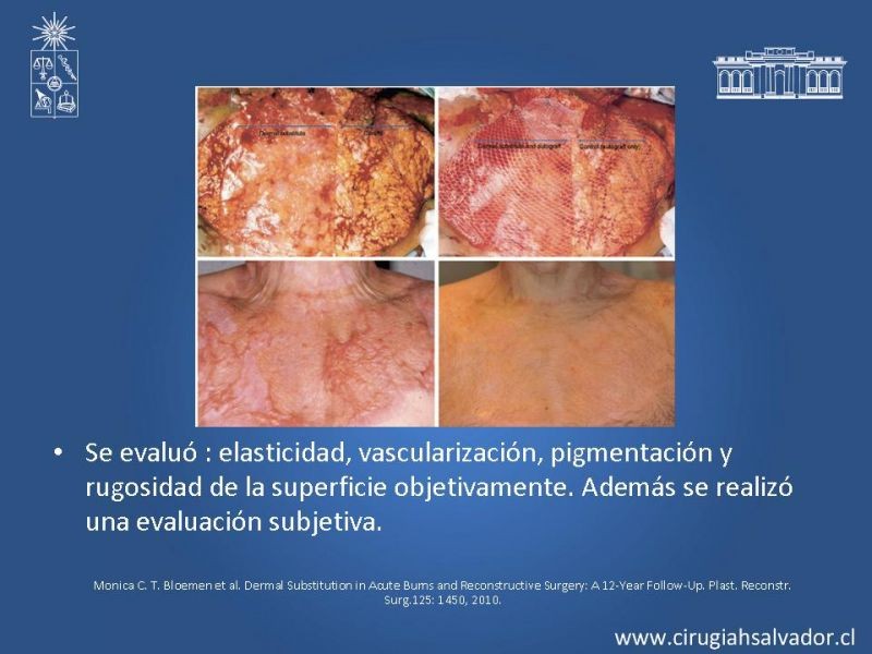 Diapositiva 19 de Sustitutos dérmicos en quemados