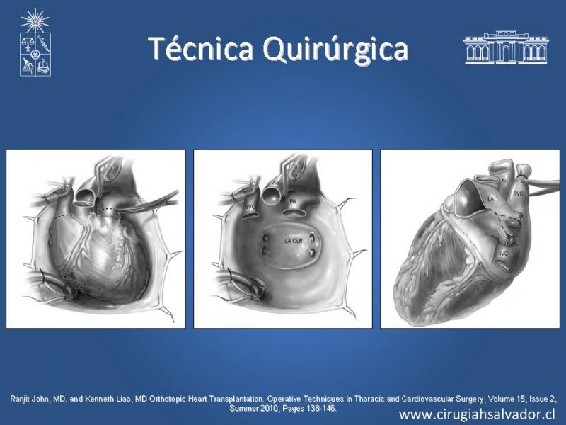 Diapositiva 22 de Trasplante Cardiaco