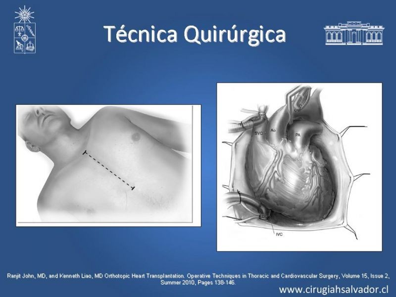 Diapositiva 21 de Trasplante Cardiaco