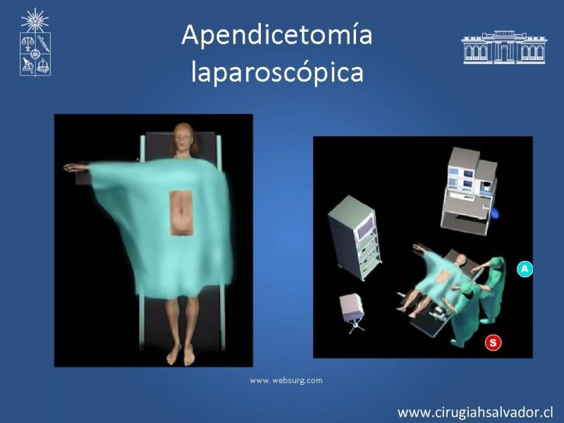 Diapositiva 9 de Apendicectomía: Abierta vs Laparoscópica 