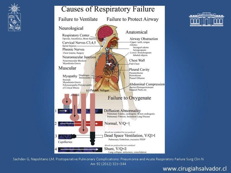 Diapositiva 51 de Complicaciones Respiratorias en el Postoperatorio: Neumonía y Falla Ventilatoria