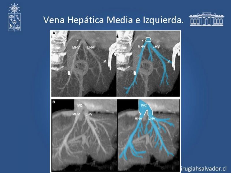 Diapositiva 33 de Segmentos Hepáticos: TC