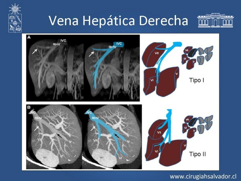 Diapositiva 29 de Segmentos Hepáticos: TC