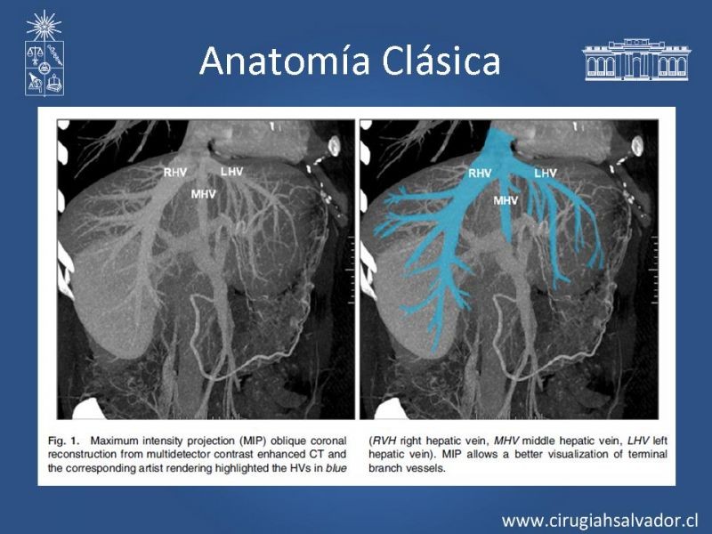 Diapositiva 25 de Segmentos Hepáticos: TC