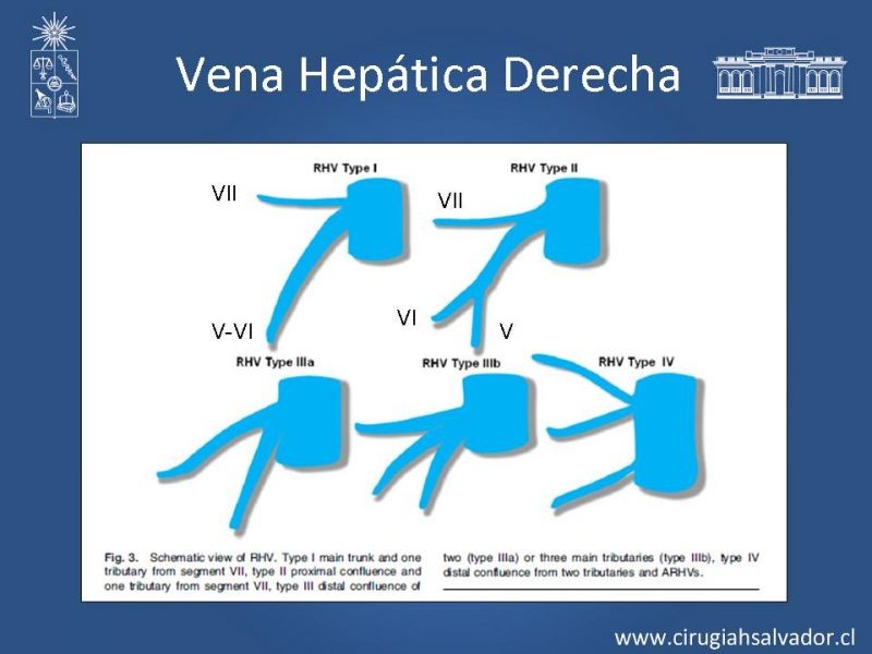 Diapositiva 28 de Segmentos Hepáticos: TC