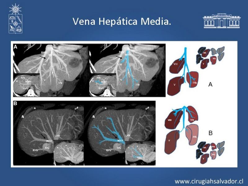 Diapositiva 34 de Segmentos Hepáticos: TC