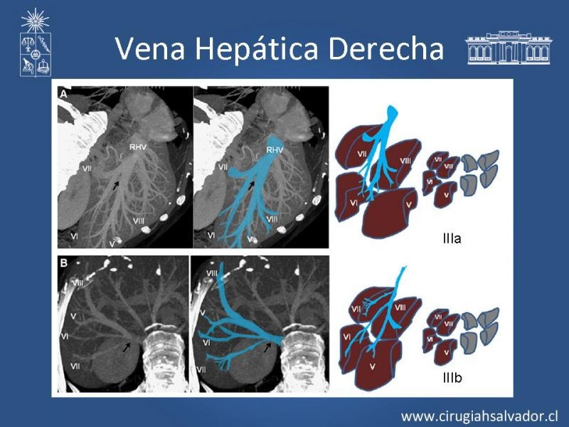 Diapositiva 30 de Segmentos Hepáticos: TC