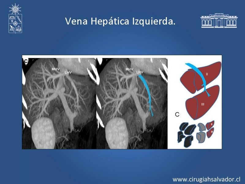 Diapositiva 38 de Segmentos Hepáticos: TC
