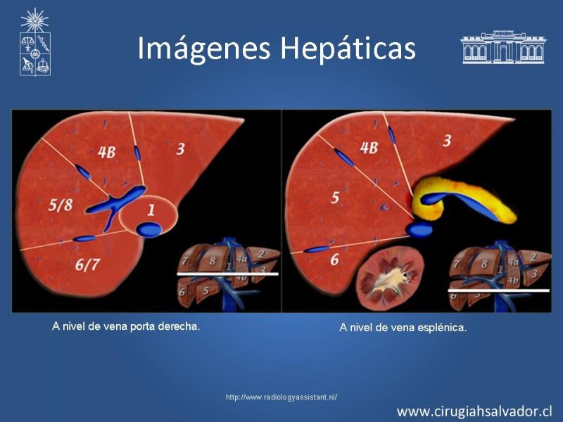Diapositiva 14 de Segmentos Hepáticos: TC