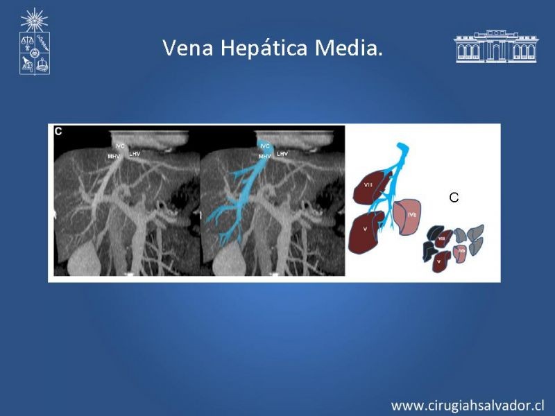 Diapositiva 35 de Segmentos Hepáticos: TC