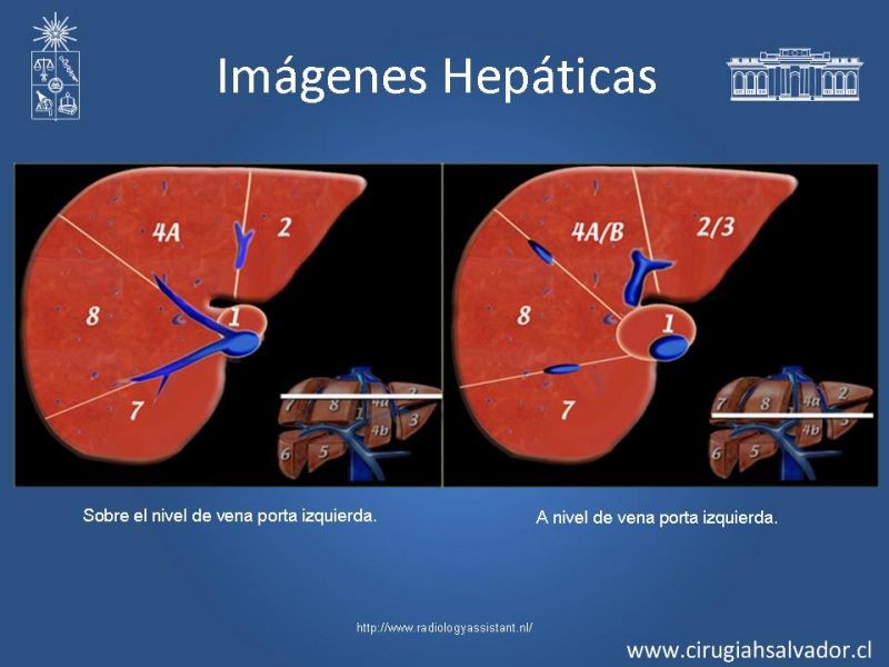 Diapositiva 13 de Segmentos Hepáticos: TC