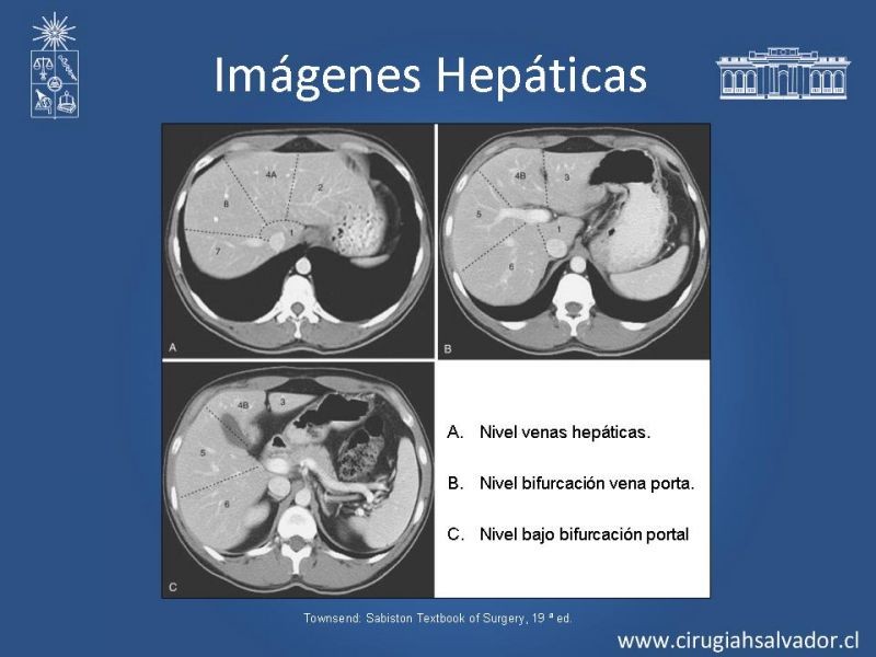 Diapositiva 15 de Segmentos Hepáticos: TC
