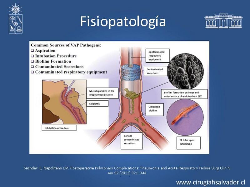 Diapositiva 21 de Complicaciones Respiratorias en el Postoperatorio: Neumonía y Falla Ventilatoria