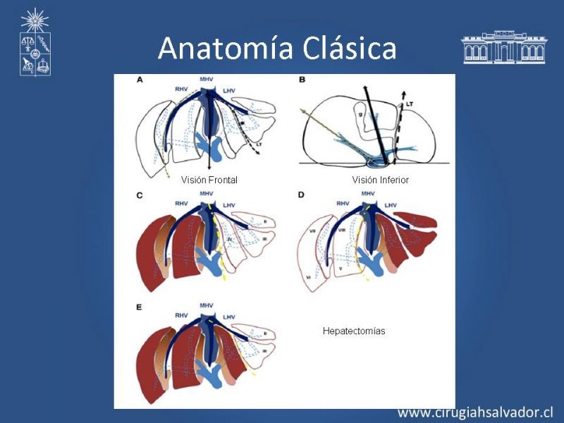 Diapositiva 26 de Segmentos Hepáticos: TC
