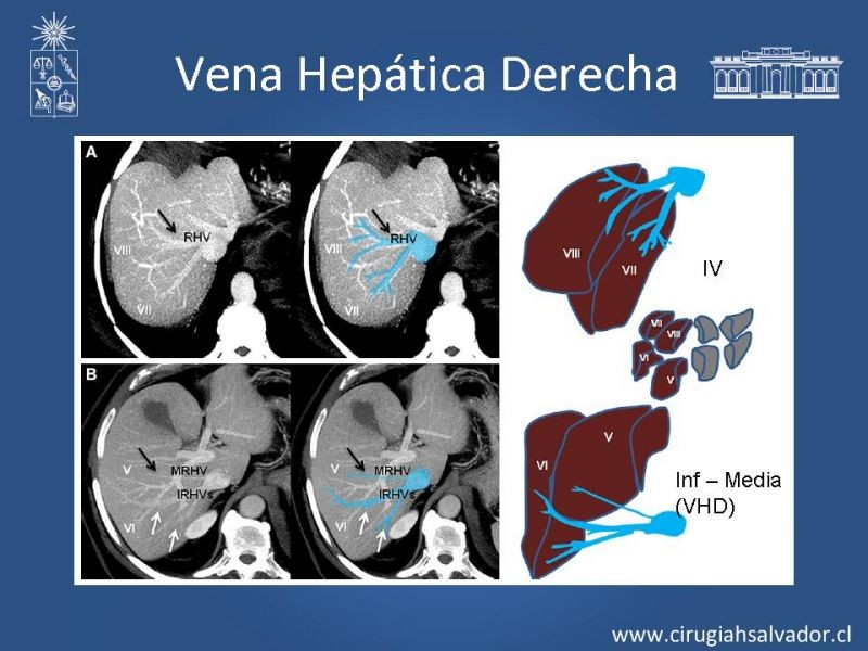 Diapositiva 31 de Segmentos Hepáticos: TC