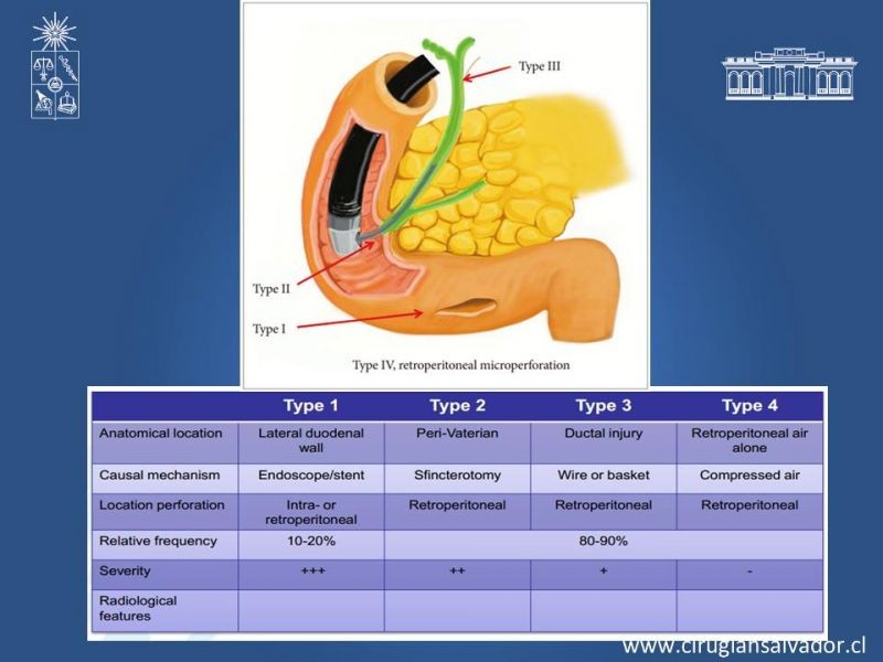 Diapositiva 9 de Sindrome de Mirizzi