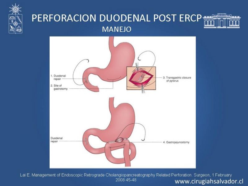 Diapositiva 18 de Sindrome de Mirizzi