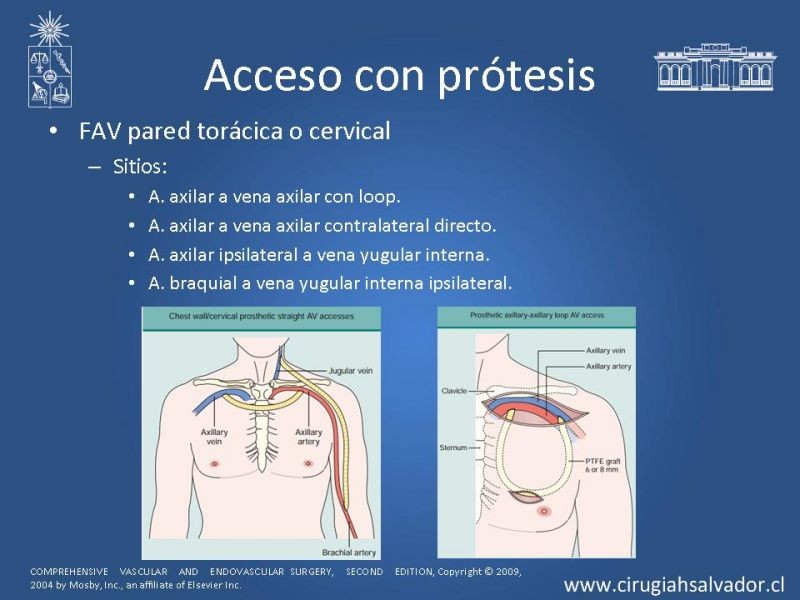 Diapositiva 14 de Accesos vasculares para hemodiálisis