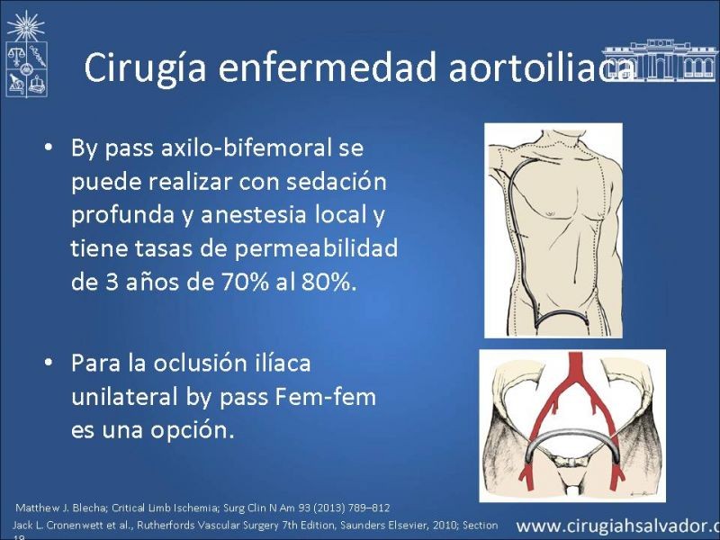 Diapositiva 21 de Tratamiento Actual de la Isquemia crítica EEII