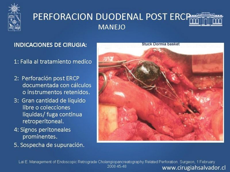 Diapositiva 21 de Sindrome de Mirizzi