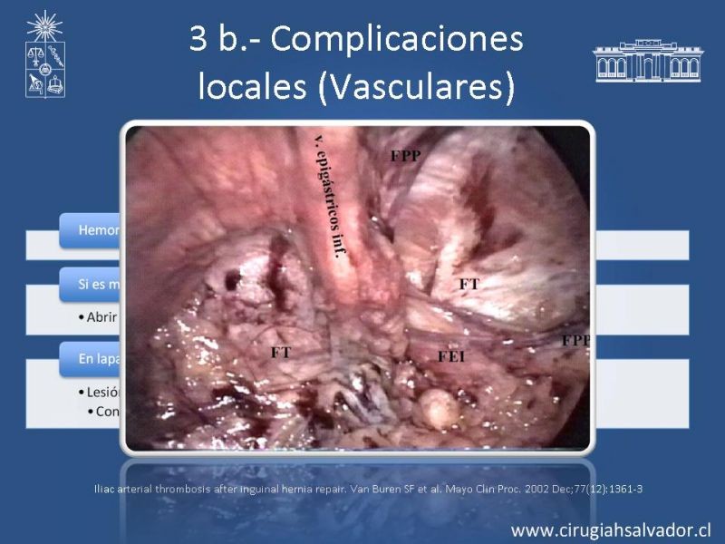 Diapositiva 12 de Hernioplastía Inguinal: Complicaciones