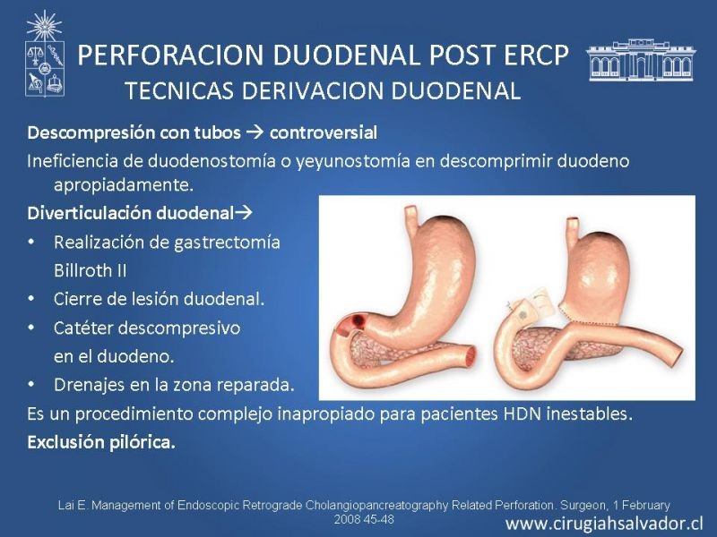 Diapositiva 16 de Sindrome de Mirizzi