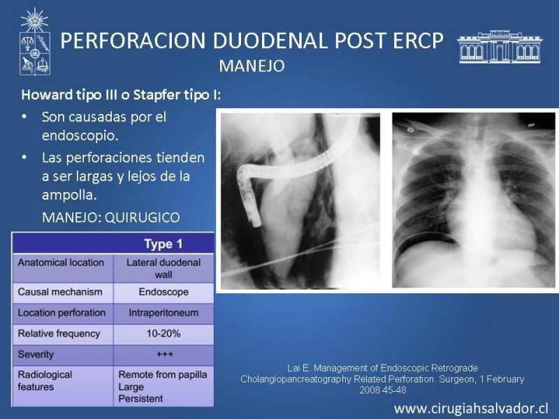 Diapositiva 13 de Sindrome de Mirizzi