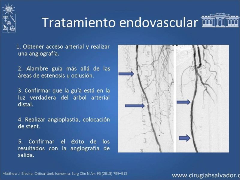 Diapositiva 15 de Tratamiento Actual de la Isquemia crítica EEII