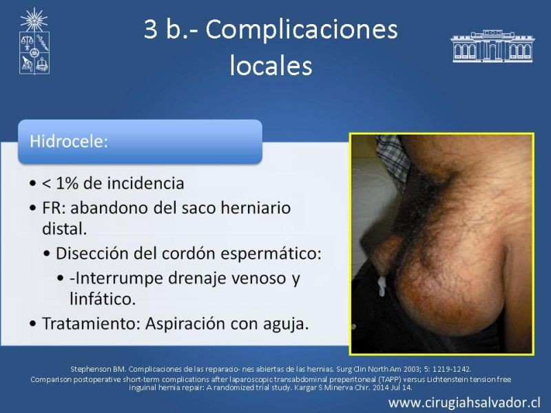 Diapositiva 7 de Hernioplastía Inguinal: Complicaciones