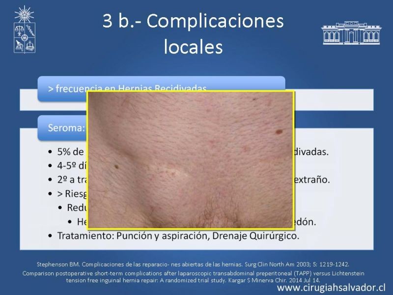 Diapositiva 6 de Hernioplastía Inguinal: Complicaciones