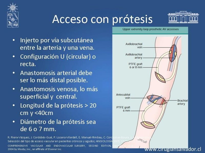 Diapositiva 13 de Accesos vasculares para hemodiálisis