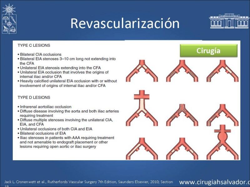 Diapositiva 12 de Tratamiento Actual de la Isquemia crítica EEII