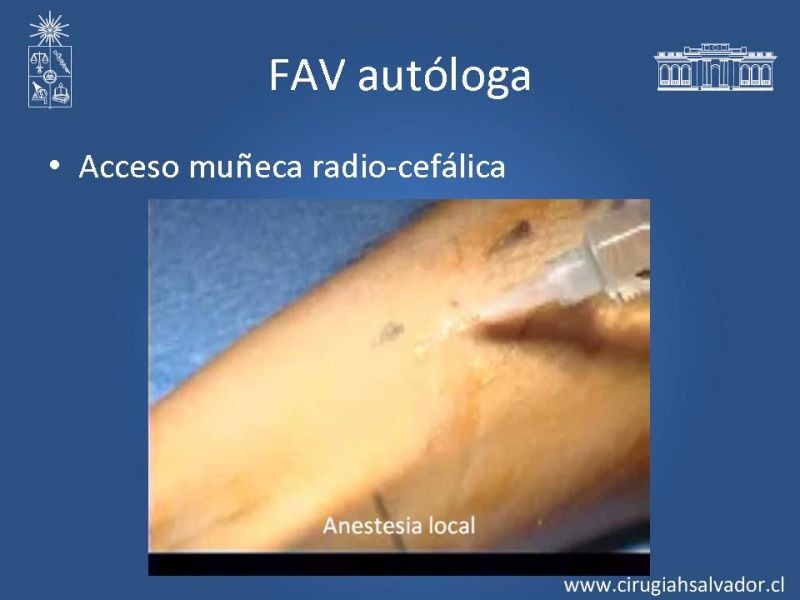 Diapositiva 8 de Accesos vasculares para hemodiálisis