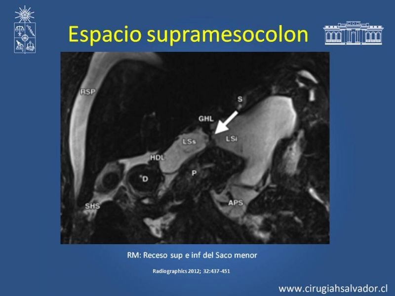 Diapositiva 28 de Anatomía Peritoneal y Retroperitoneal