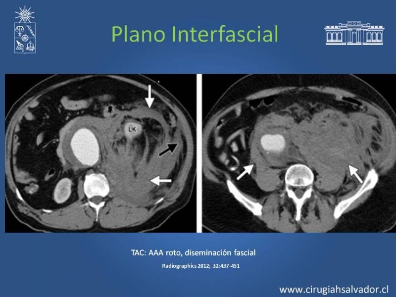 Diapositiva 49 de Anatomía Peritoneal y Retroperitoneal