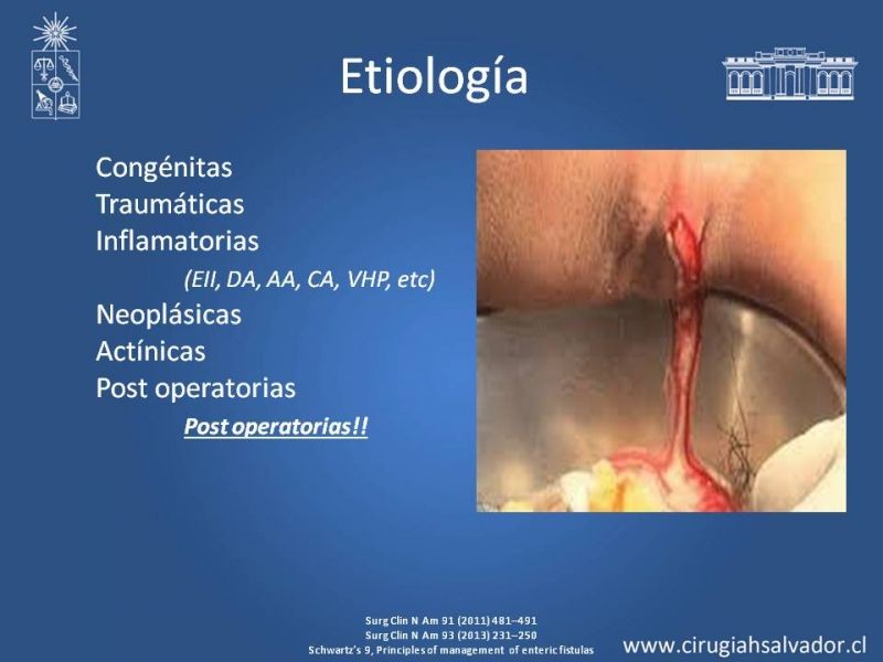 Diapositiva 2 de Fístulas Intestinales
