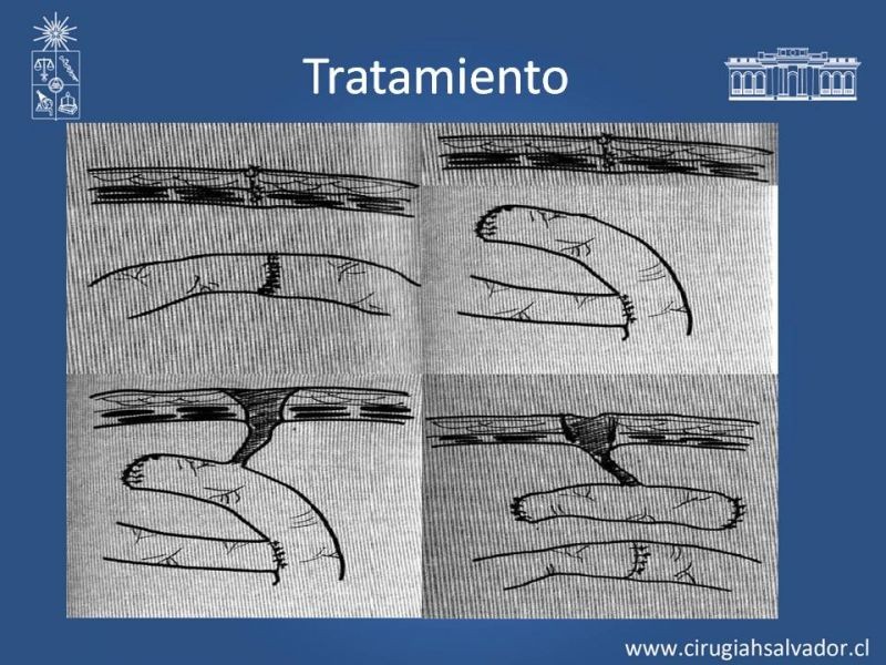 Diapositiva 16 de Fístulas Intestinales